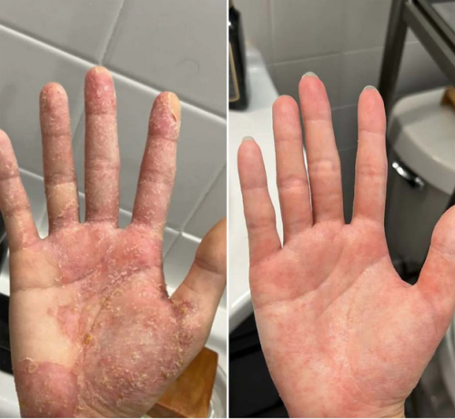 Krem na Zapalenie Skóry & Zdrowa Skóra – Łagodzi swędzenie, zaczerwienienie i łuszczenie 50ml photo review